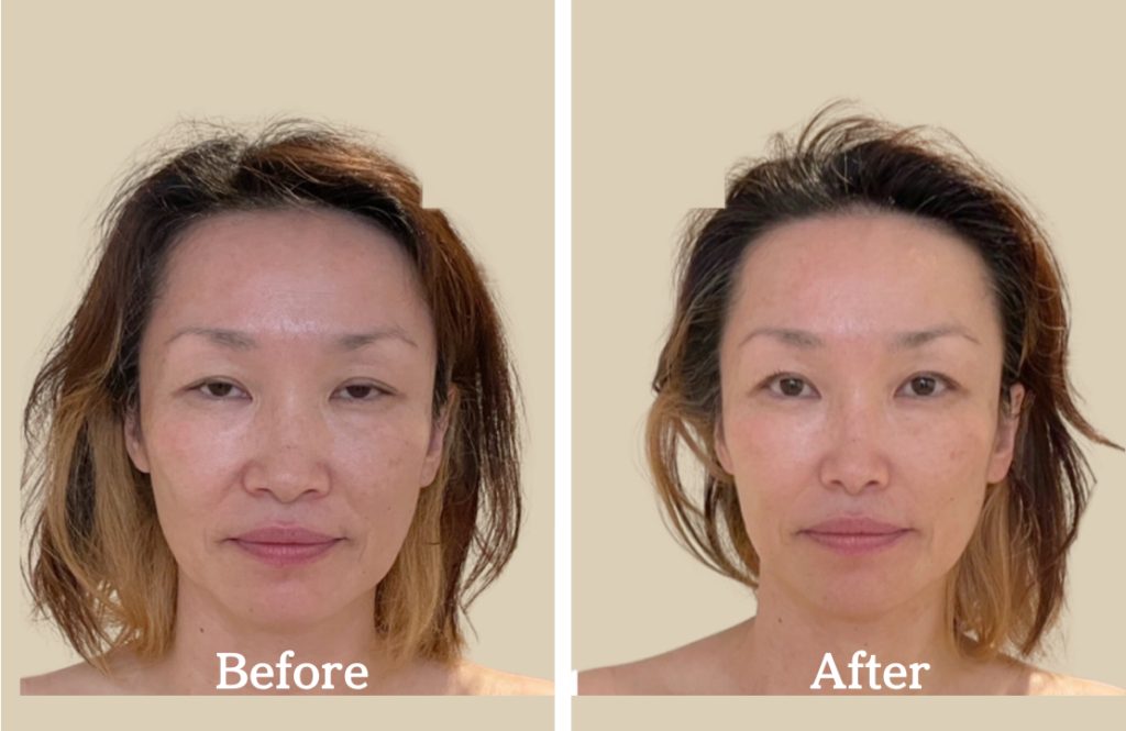 ほうれい線が薄くなり目がパッチリした施術例