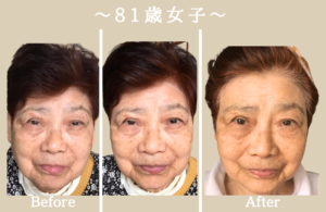 8_ before after N 小顔矯正